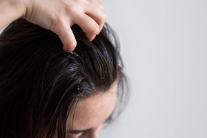Punya Rambut Ketombe? Ini Tips dan Cara Alami Agar Tampil Percaya Diri