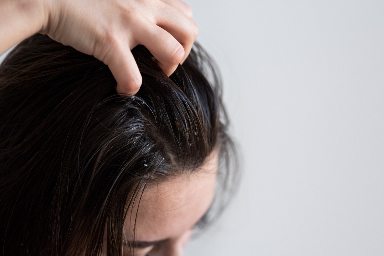 Punya Rambut Ketombe? Ini Tips dan Cara Alami Agar Tampil Percaya Diri