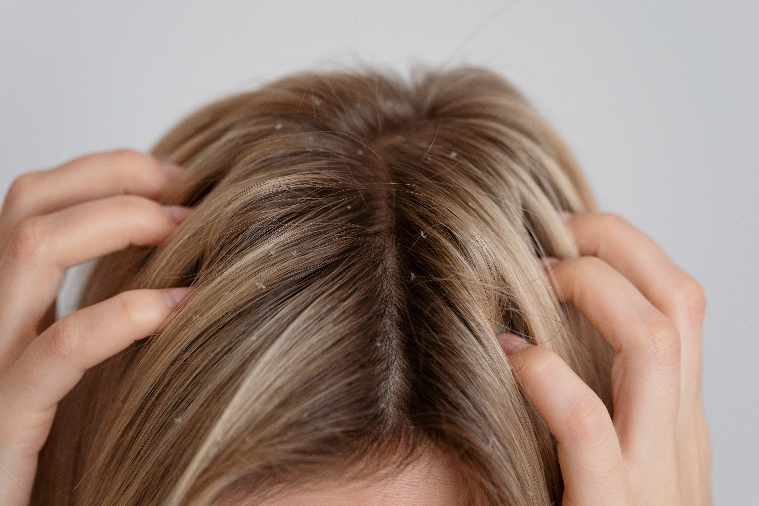 7 Penyebab Kulit Kepala Berminyak yang Bikin Rambut Lepek