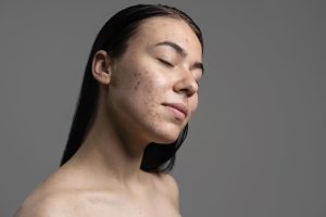 5 Cara Hilangkan Bopeng di Wajah dengan Bahan Alami, Putih Telur?