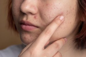 5 Bahan Alami untuk Hilangkan Bekas Jerawat, Ada Kentang
