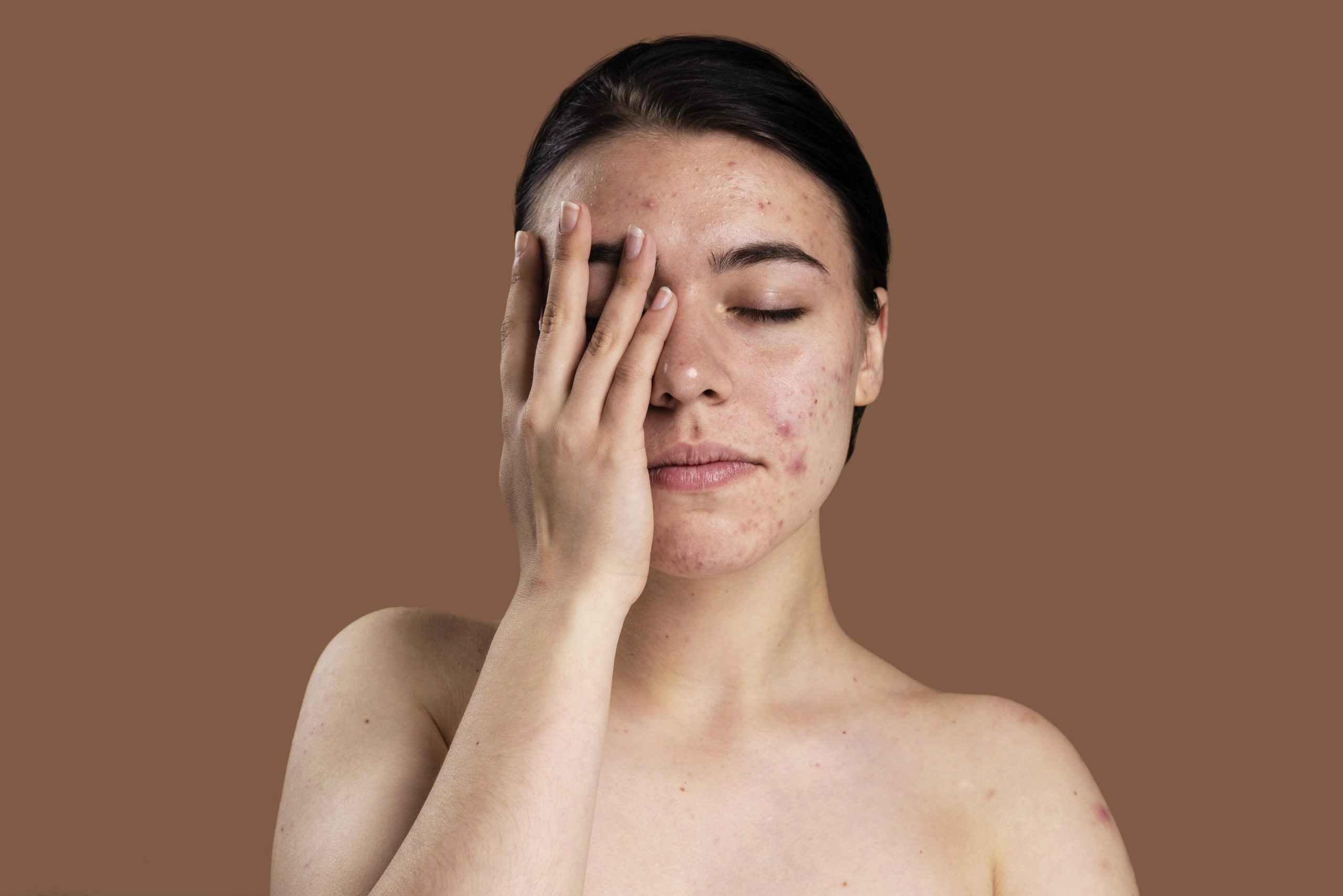 5 Cara Cegah Purging di Wajah Usai Pemakaian Skincare Baru