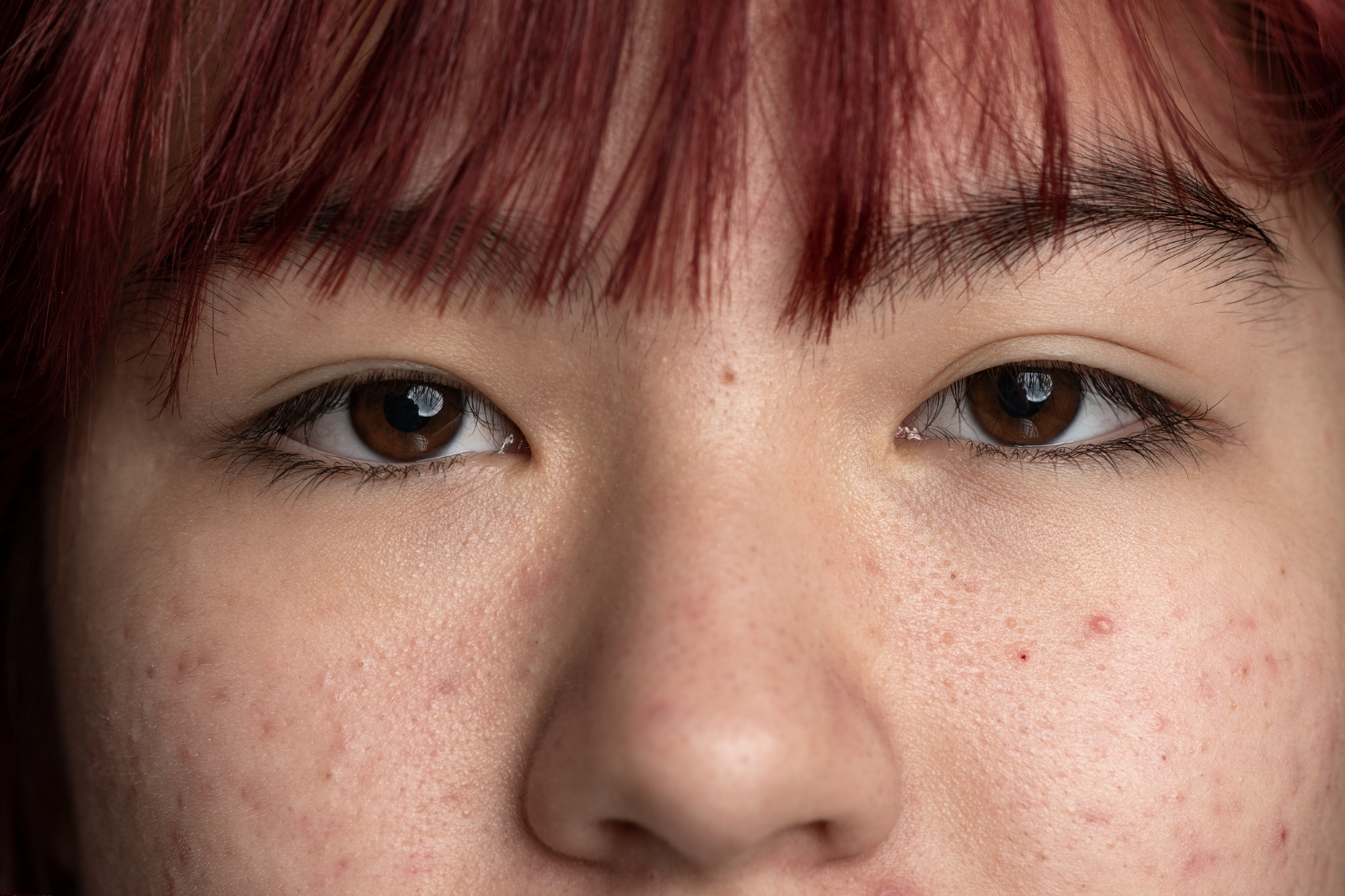 Kenali Penyebab Milia di Wajah dan Cara Mencegahnya dengan Tepat